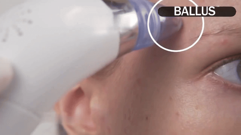 Electric Facial Pore Cleansing Vacuum Device
